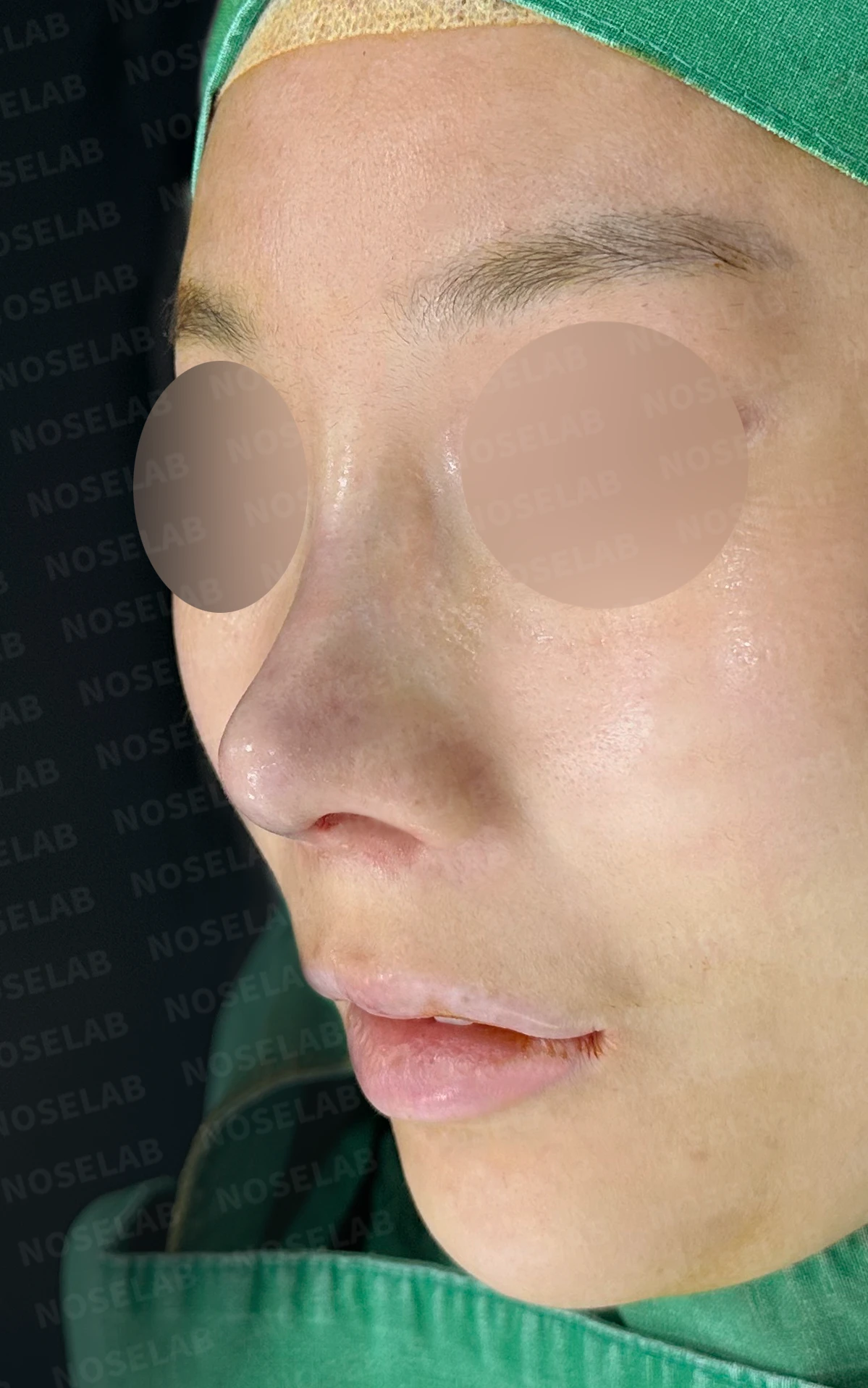 비중격 천공이 생기면 무엇이 문제이고 어떻게 재건하나 — 수술 직후 0일 정면, 비스듬한 측면, 측면 사진입니다. 직후 사진은 부기가 있는 상태로 최종 결과와 다를 수 있습니다.