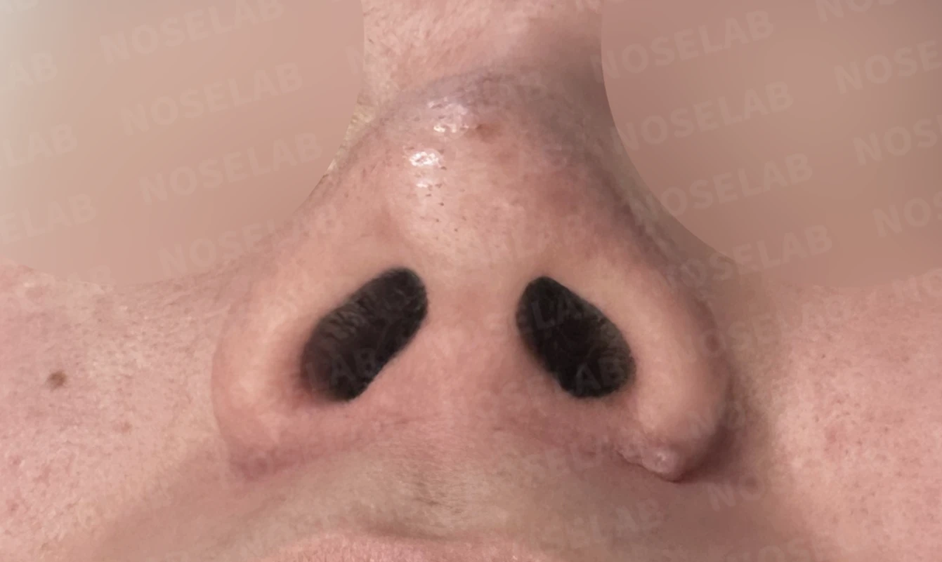 콧대를 더 높이고 싶을 때 무엇이 한계를 만드나, 3D 맞춤 보형물과 자가늑연골 코끝 지지 — 수술 전 / 수술 직후 0일 직후 사진은 부기가 있는 상태로 최종 결과와 다를 수 있습니다.