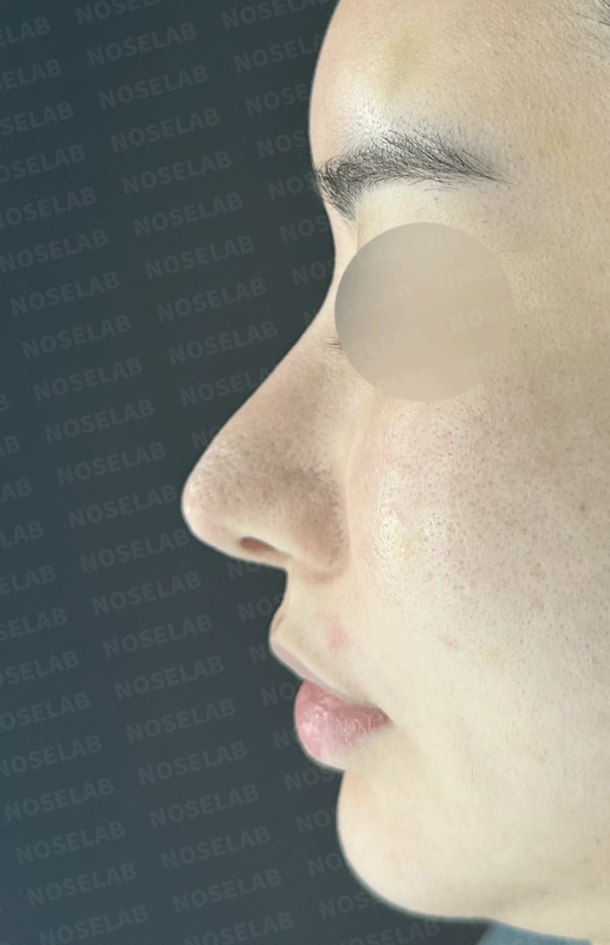 코가 과하게 높아져 부자연스러워 보이고 휘는 이유, 재건은 어떻게 하나 — 수술 전 / 수술 직후 0일 직후 사진은 부기가 있는 상태로 최종 결과와 다를 수 있습니다.