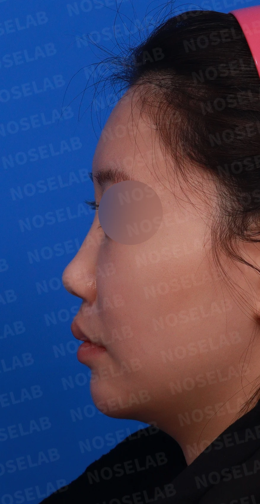 필러와 실이 남아 있는 코, 제거 후 늑연골 재건은 어디까지 가능한가 — 디자인 상담 정면, 좌측 측면, 비스듬한 측면 사진