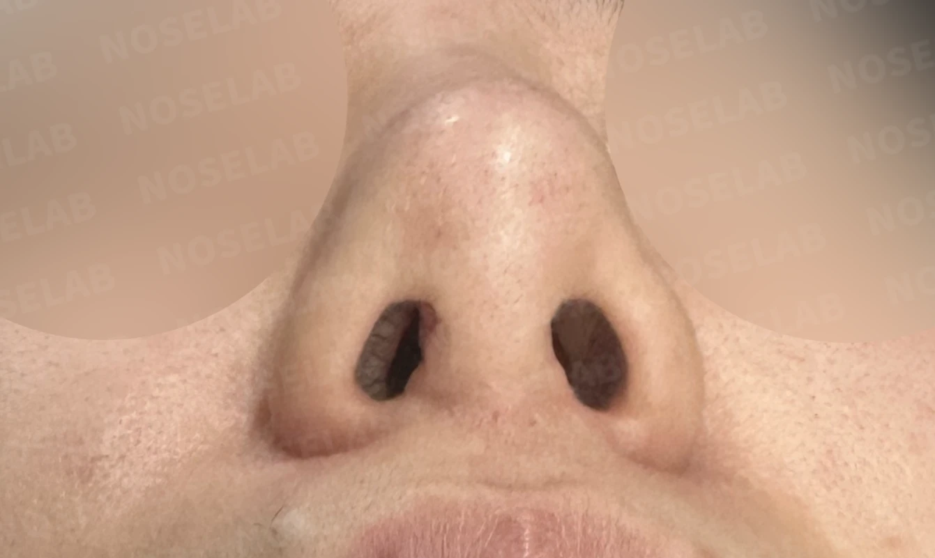 이전 수술 뒤 코가 딱딱해지고 짧아지는 구축, 왜 생기고 어떻게 재건하나 — 수술 전 / 수술 직후 0일 직후 사진은 부기가 있는 상태로 최종 결과와 다를 수 있습니다.