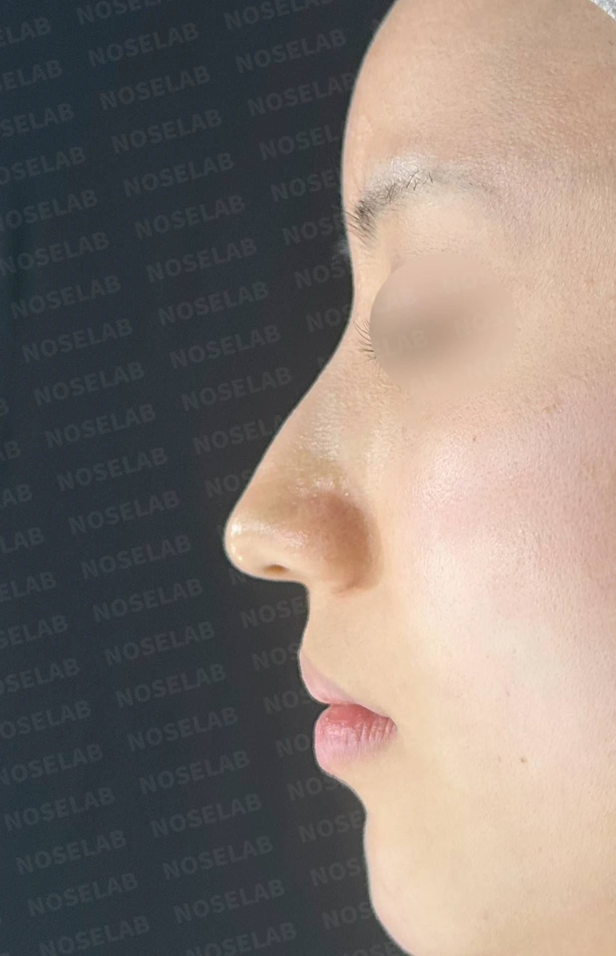 매부리코와 긴 코에 코막힘이 겹치는 이유, 교정은 어떻게 하나 — 수술 전 / 수술 직후 0일 직후 사진은 부기가 있는 상태로 최종 결과와 다를 수 있습니다.