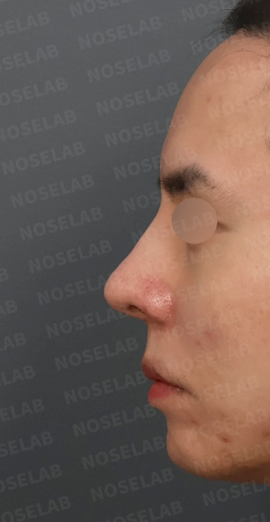 코재수술과 코막힘 교정, 기능과 심미 모두 잡은 비개방 코성형 사례 — 디자인 상담 정면, 좌측 측면, 비스듬한 측면 사진입니다.