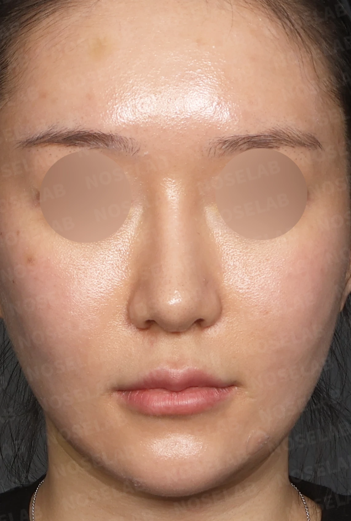 뭉툭하고 처진 긴코, 비개방 코재수술로 여성스러운 직반라인 완성 — 디자인 상담 정면, 좌측 측면, 비스듬한 측면 사진입니다.