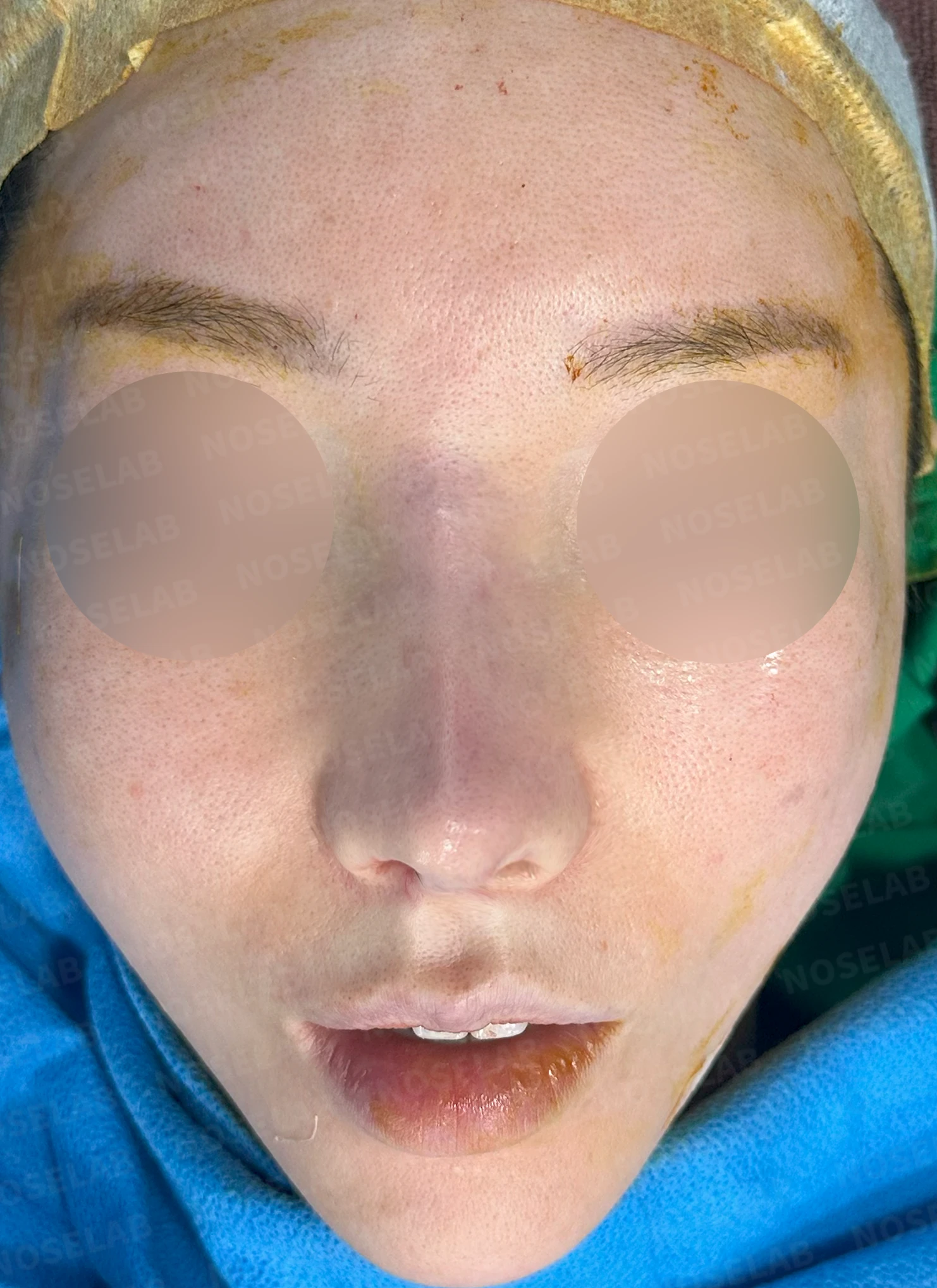 반복된 코성형 뒤 구축과 코막힘이 함께 생기는 이유, 재건은 어떻게 하나 — 수술 직후 0일 정면, 비스듬한 측면, 측면 사진입니다. 직후 사진은 부기가 있는 상태로 최종 결과와 다를 수 있습니다.