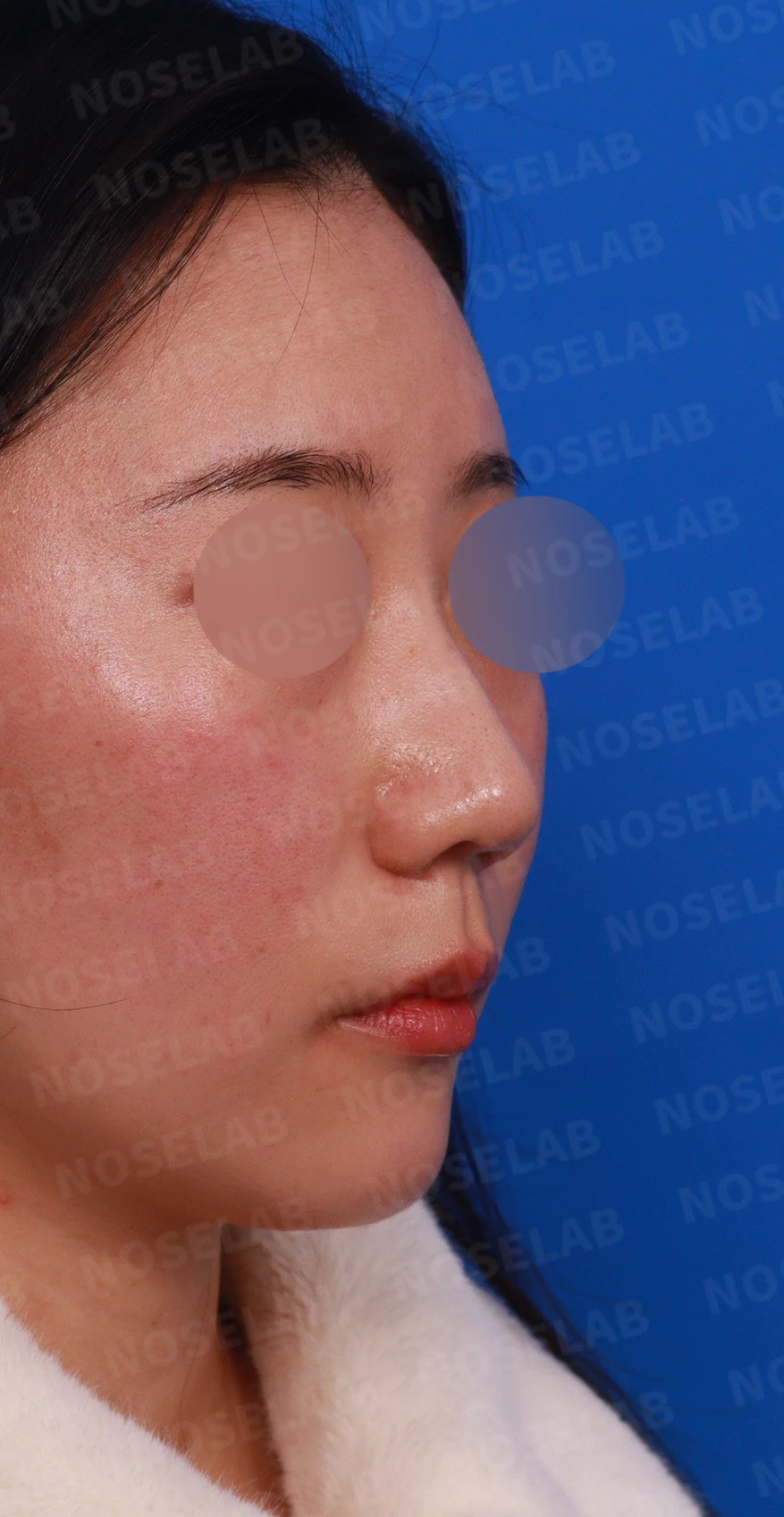 코뼈 비대칭과 처진 코끝에 만성 비염이 겹칠 때 보는 것 — 디자인 상담 정면, 우측 측면, 비스듬한 측면 사진