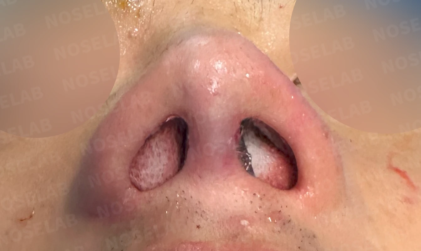 비염 수술 뒤에도 증상이 재발하는 이유, 휜 코를 함께 교정하는 방법 — 수술 직후 0일 비공 사진 직후 사진은 부기가 있는 상태로 최종 결과와 다를 수 있습니다.