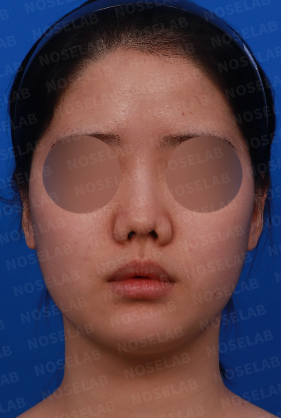 이전 수술 뒤 콧구멍이 좁아지는 비공협착, 원인과 재건 방법 — 디자인 상담 정면, 좌측 측면, 비스듬한 측면 사진입니다.