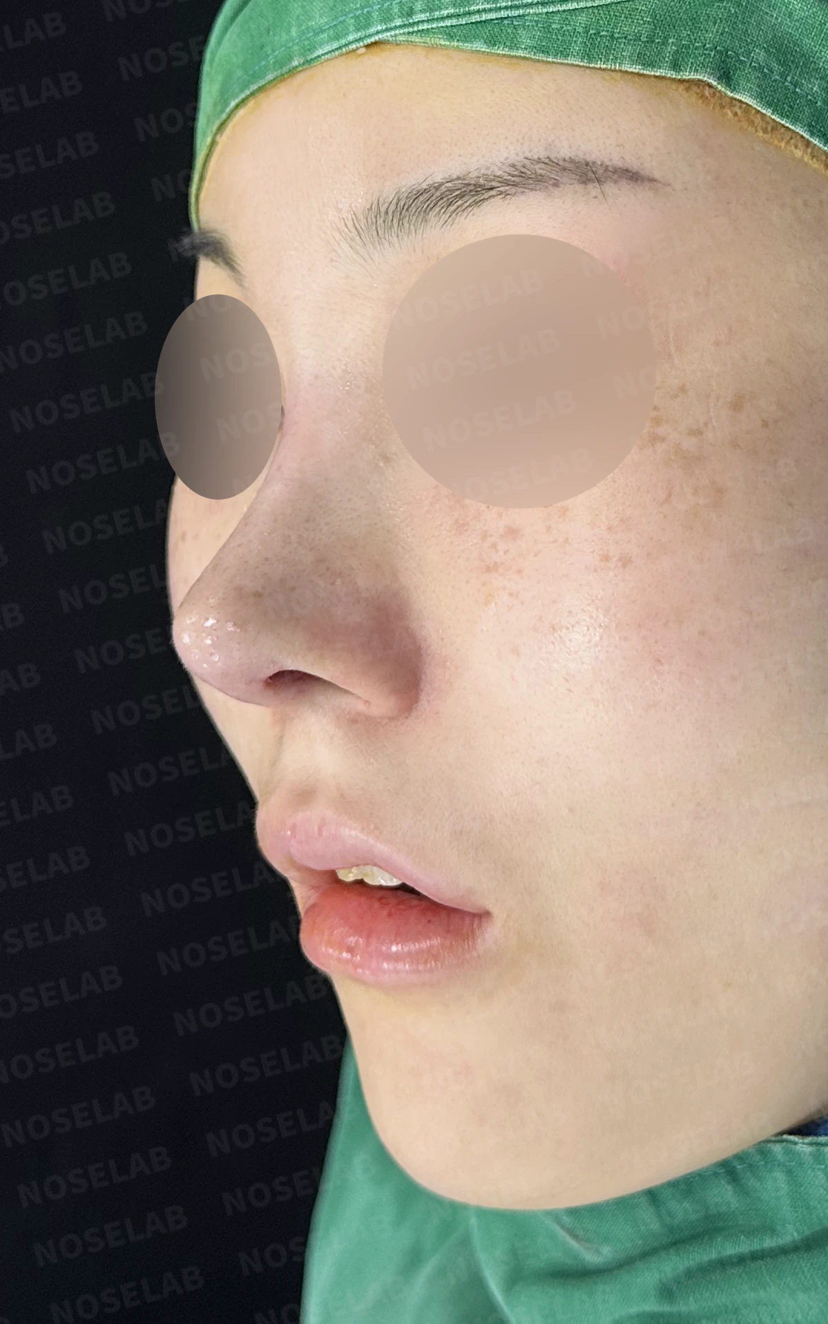 길고 뭉툭한 코, 자가늑연골로 화려하면서 자연스럽게 — 직후 정면, 비스듬한 측면, 측면 사진입니다.