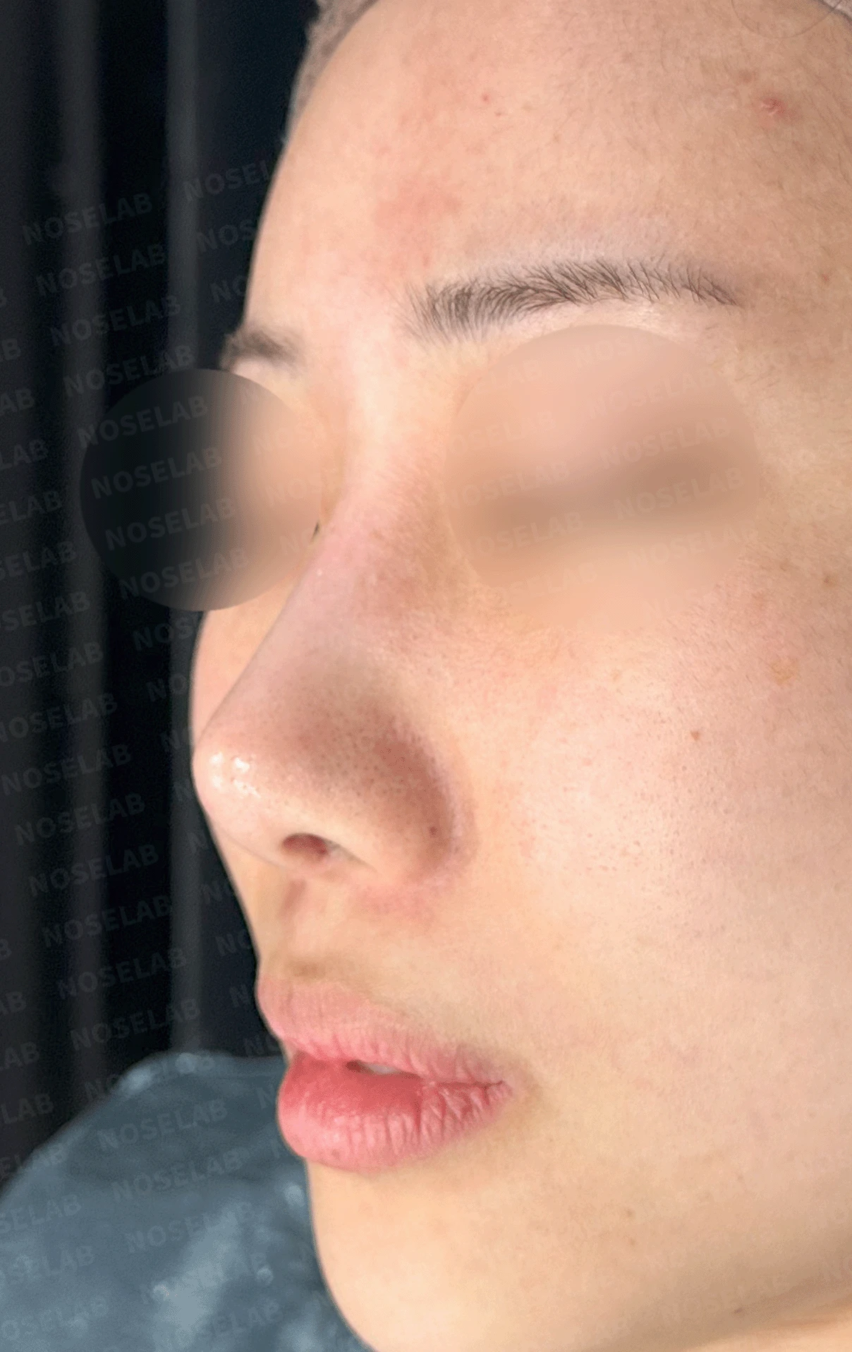 인위적인 코에서 자연스러운 아름다움으로 - 맞춤형 코 재건술 사례 — 본문 사진 11