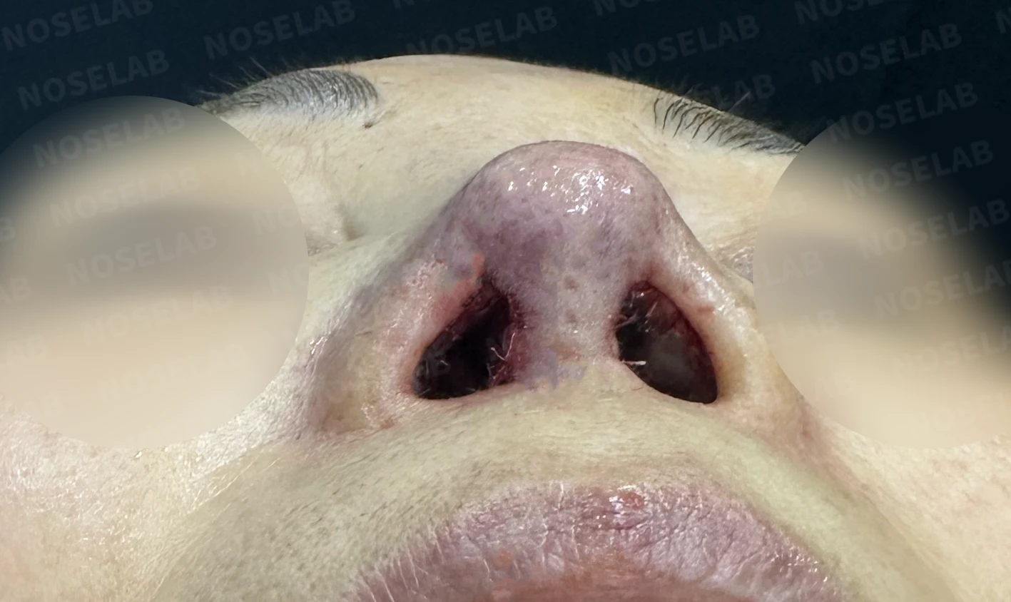비중격 천공이 있는 코의 재수술 계획 — 수술 전 / 수술 직후 0일 직후 사진은 부기가 있는 상태로 최종 결과와 다를 수 있습니다.
