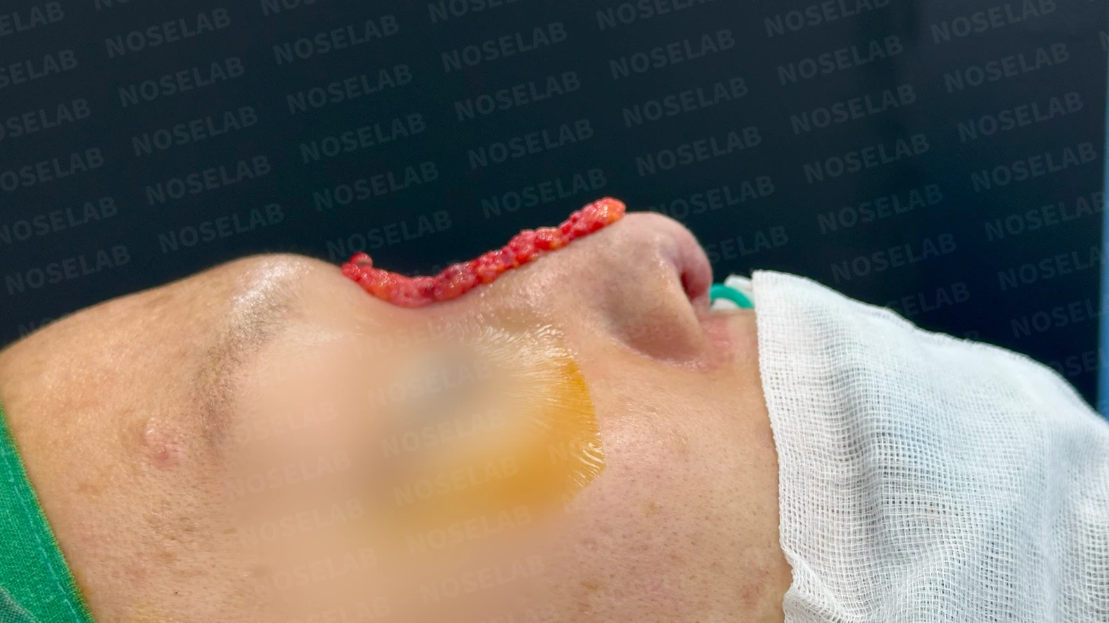 주입된 이물질을 제거하고 코를 재건하는 방법 — 제거된 이물질 사진 이물질이 제거된 사진