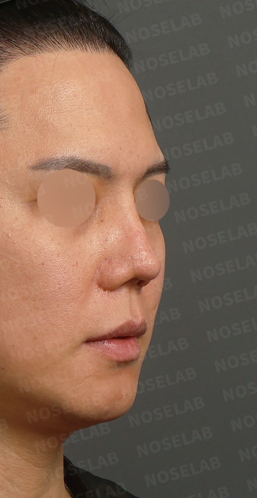 여러 차례 코재수술 후 구축 변형, 자가늑연골로 재건한 사례 — 디자인 상담 우측 측면, 비스듬한 측면, 비공 사진입니다.