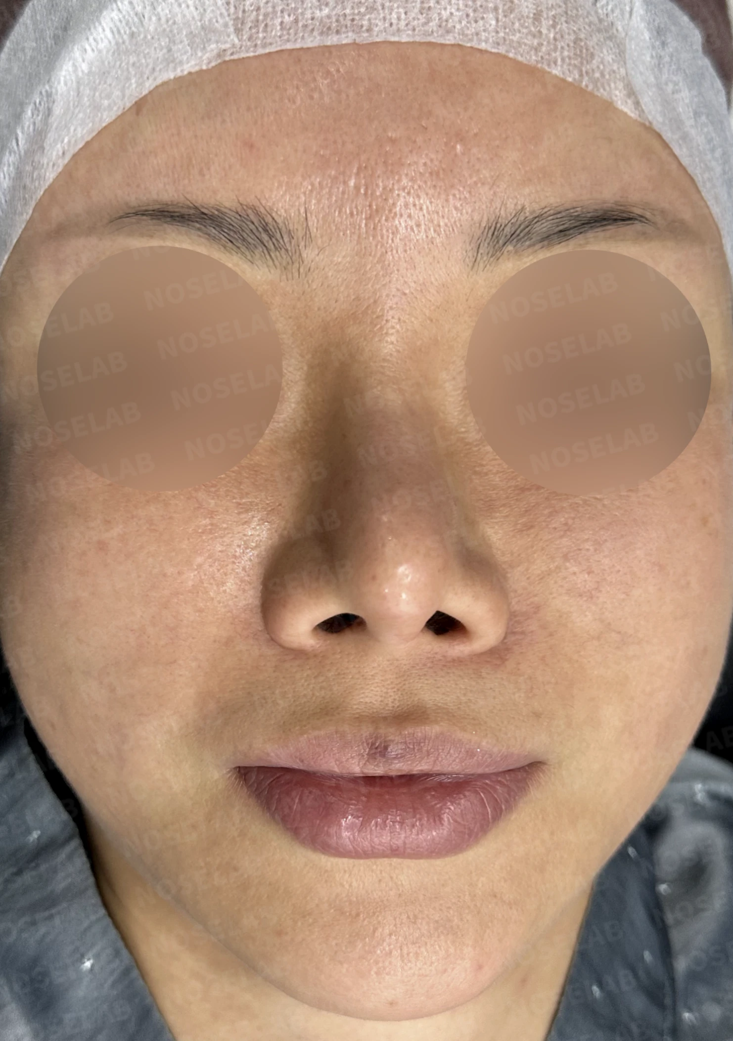 비중격 소실 후 들린 코끝과 찝혀 보이는 콧날개, 자가늑연골로 정밀 재건 — 전(좌) 직후(후)