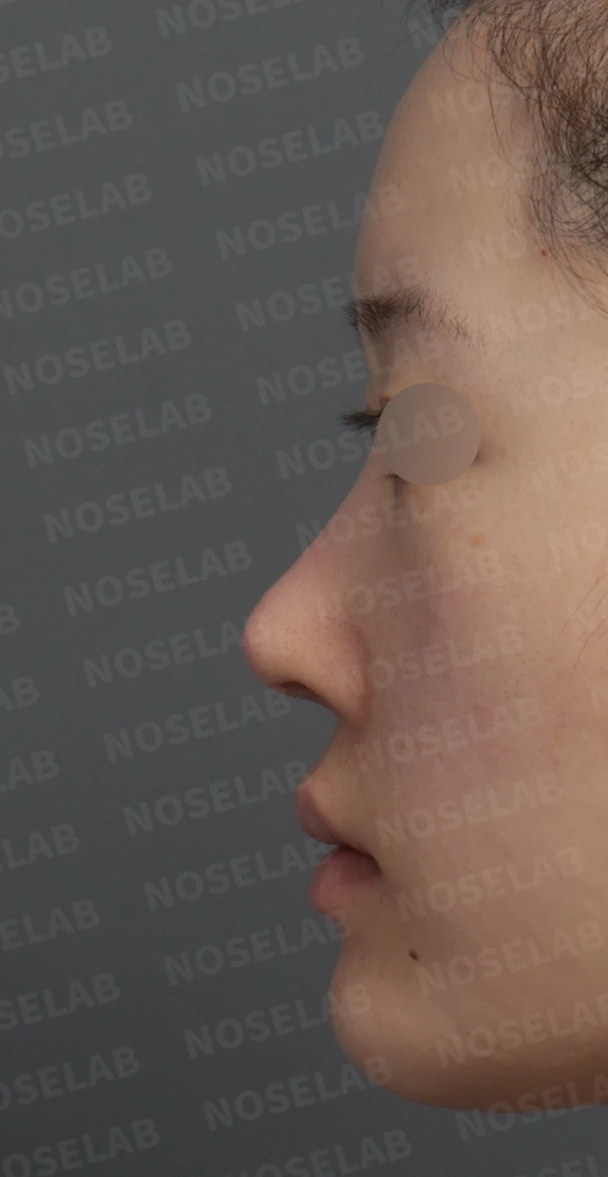 보형물 비침과 들린 코, 자가늑연골로 안전하게 교정한 코재수술 — 디자인 상담 정면 , 좌측 비스듬한 측면 , 측면 사진입니다.