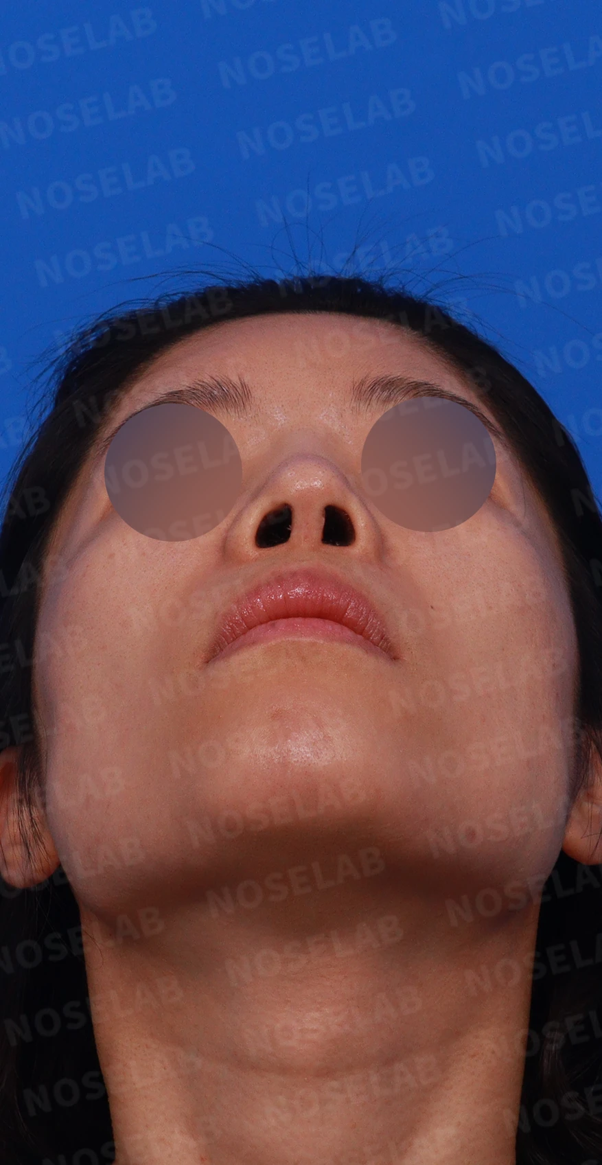 코 수술 뒤 염증이 오래 지속되면 생기는 변화와 재건 방법 — 디자인 상담 우측 측면, 비스듬한 측면, 비공 사진입니다.