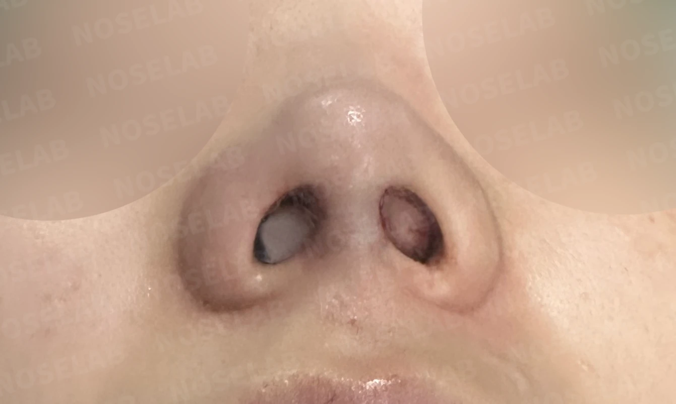 연골 노출 복원과 날개 연골 재건으로 안전하고 자연스러운 코 — 직후 비공 사진입니다.