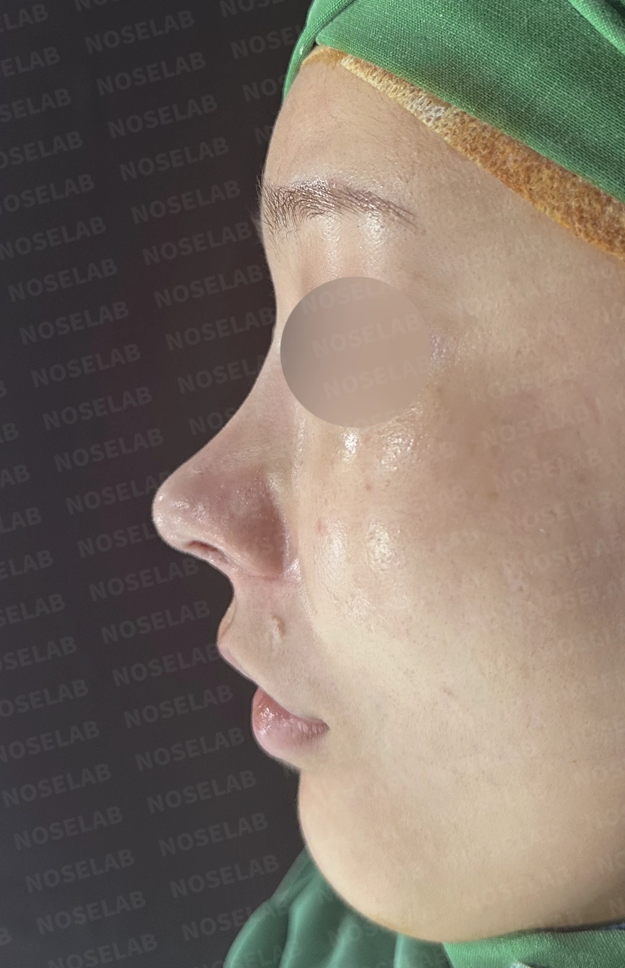 연골 노출 복원과 날개 연골 재건으로 안전하고 자연스러운 코 — 직후 정면, 비스듬한 측면, 측면 사진입니다.