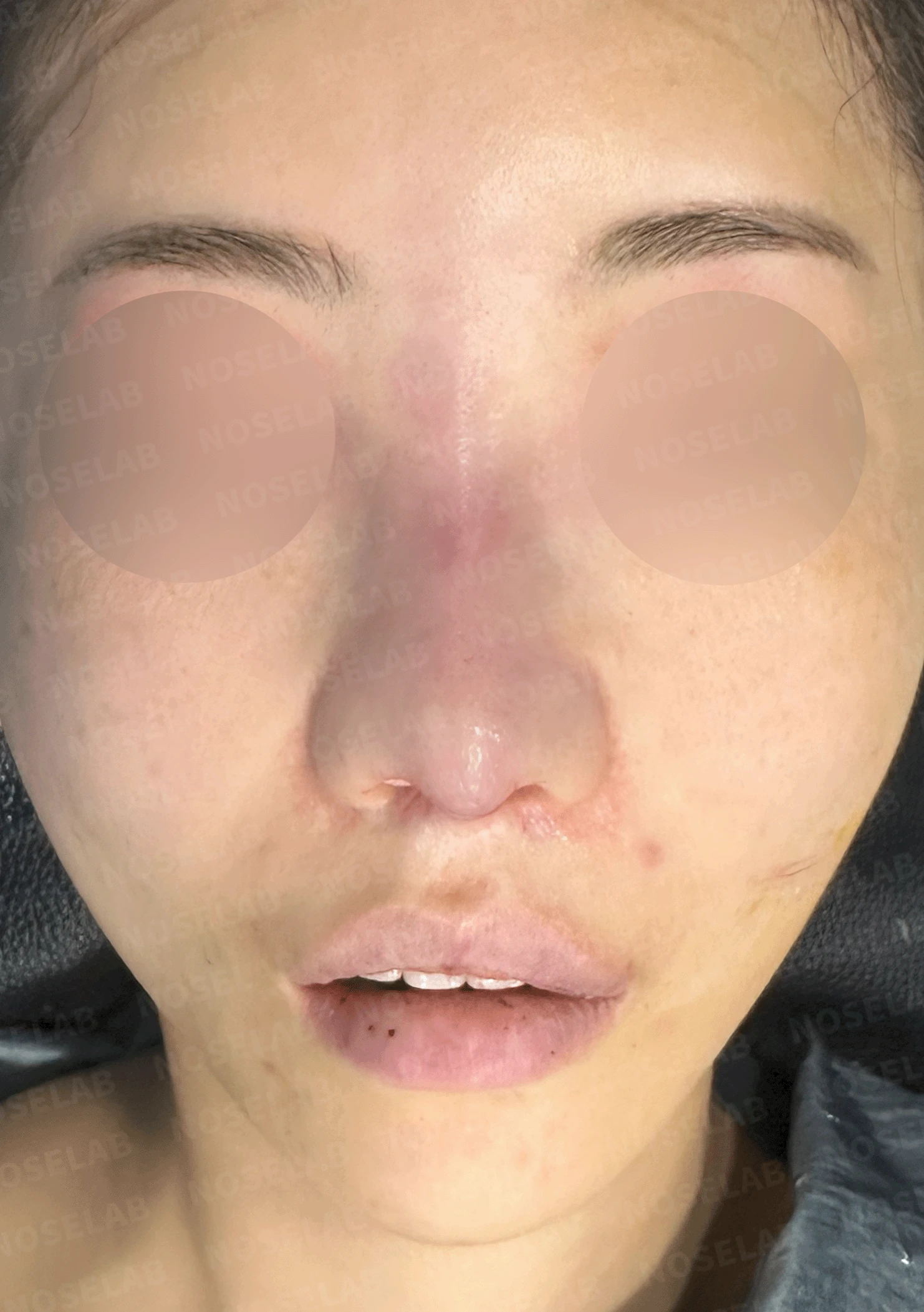 이전 수술로도 달라지지 않는 뭉툭한 코끝, 원인과 재건 방법 — 수술 직후 0일 정면 , 비스듬한 측면 , 측면 사진입니다. 직후 사진은 부기가 있는 상태로 최종 결과와 다를 수 있습니다.