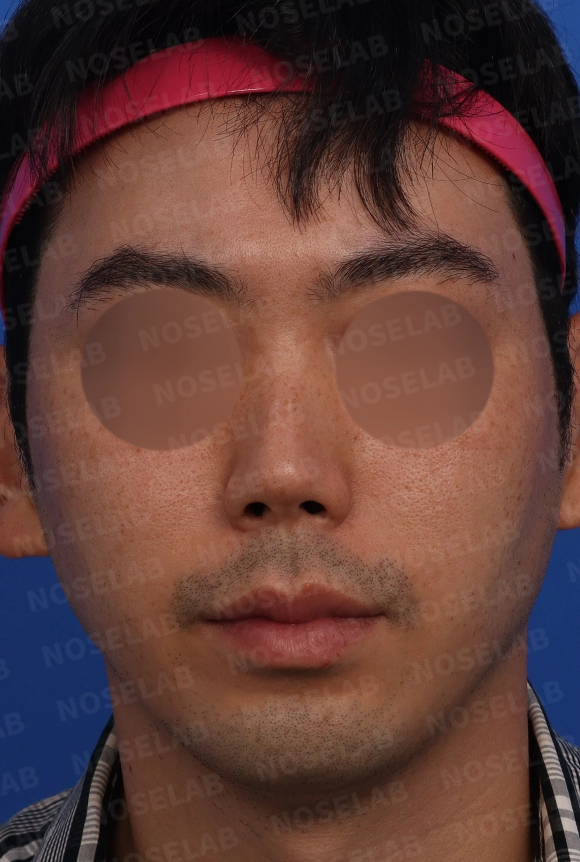 휜코와 매부리코, 짧은 코의 구조 및 교정 방법 — 본문 사진 1