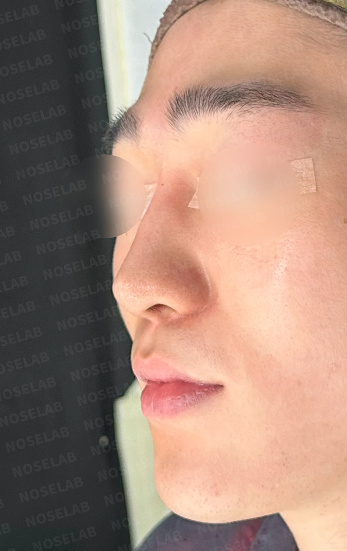 코골절과 반복 재수술 뒤 남는 흉터 조직과 비공 비대칭, 재건 방법 — 수술 전 / 수술 직후 0일 직후 사진은 부기가 있는 상태로 최종 결과와 다를 수 있습니다.