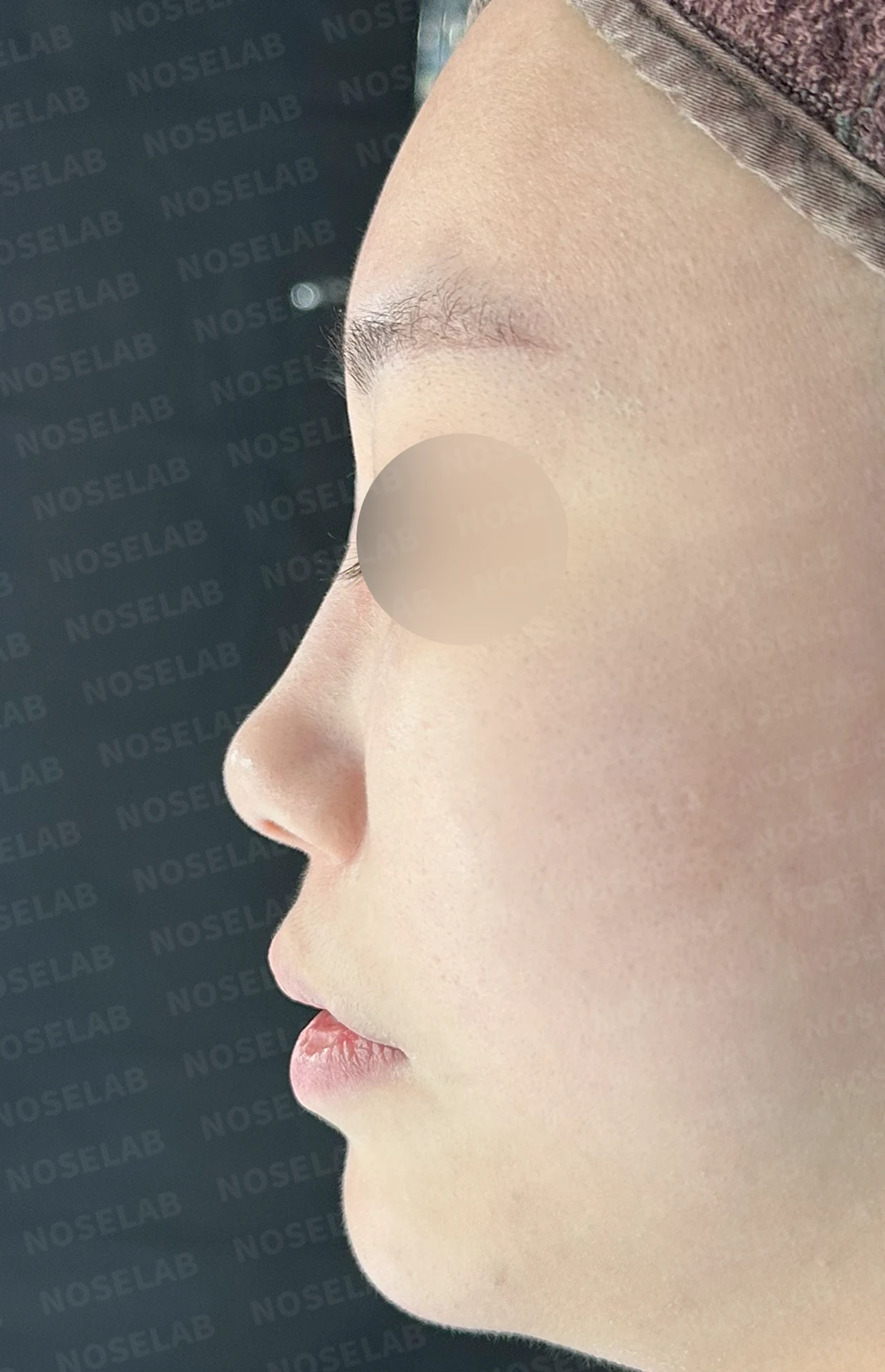 필러와 실이 남아 있는 코, 제거 후 늑연골 재건은 어디까지 가능한가 — 수술 전 / 수술 직후 0일 직후 사진은 부기가 있는 상태로 최종 결과와 다를 수 있습니다.