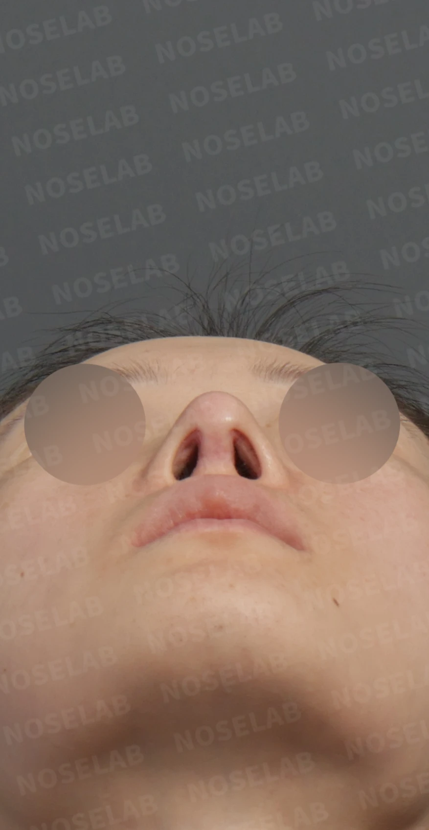 보형물 비침과 들린 코, 자가늑연골로 안전하게 교정한 코재수술 — 디자인 상담 우측 측면 , 비스듬한 측면 , 비공 사진입니다.