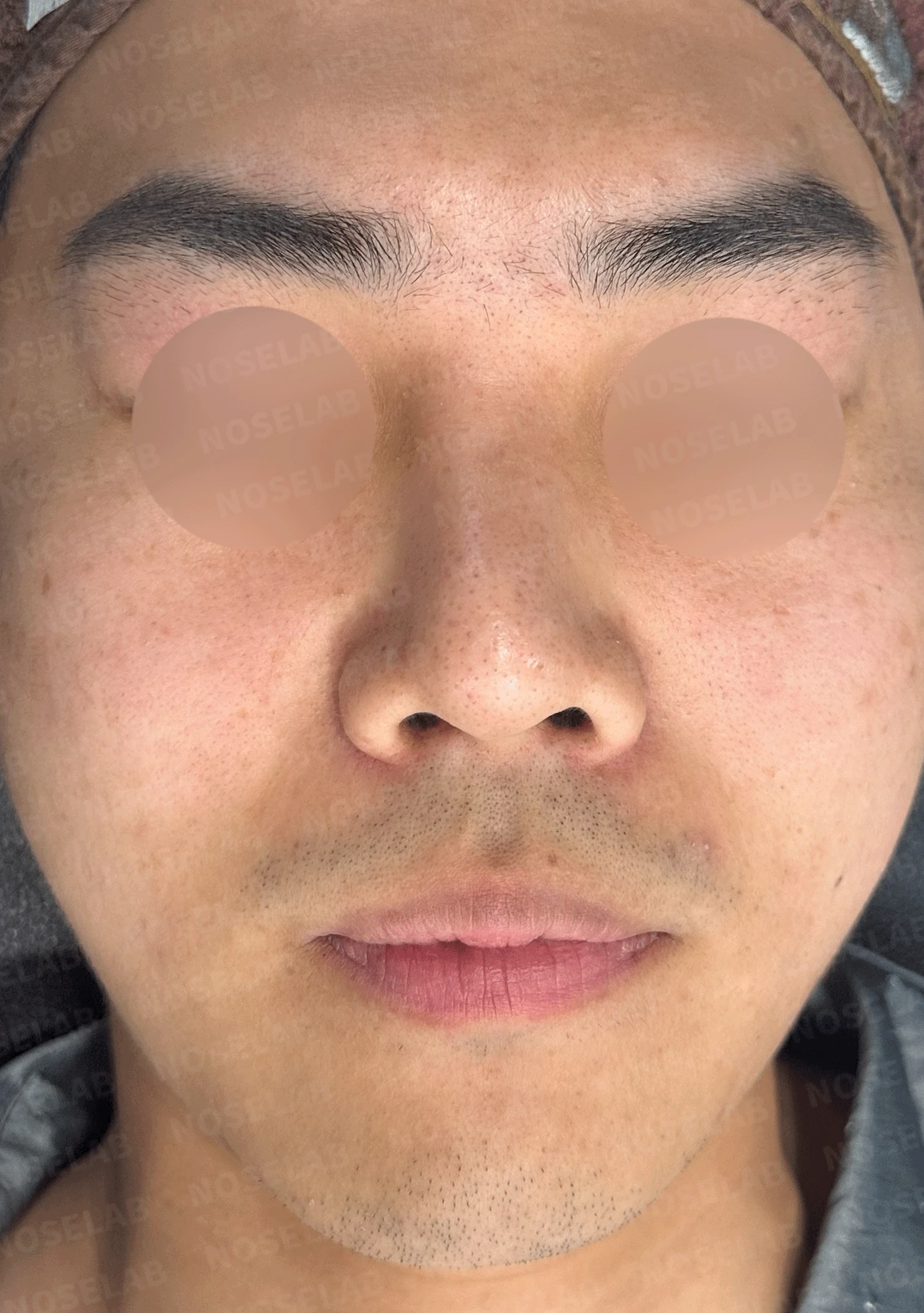 휜 코와 비공 노출 개선 - 자연스러운 코끝 상승 사례 — 본문 사진 7