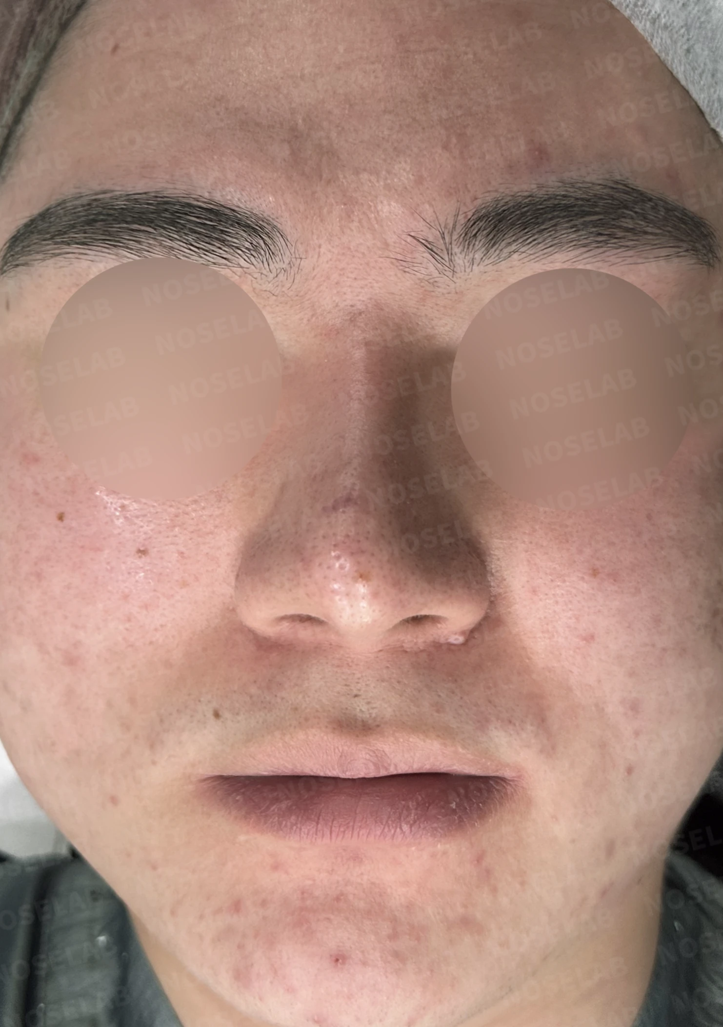 콧대를 더 높이고 싶을 때 무엇이 한계를 만드나, 3D 맞춤 보형물과 자가늑연골 코끝 지지 — 수술 전 / 수술 직후 0일 직후 사진은 부기가 있는 상태로 최종 결과와 다를 수 있습니다.