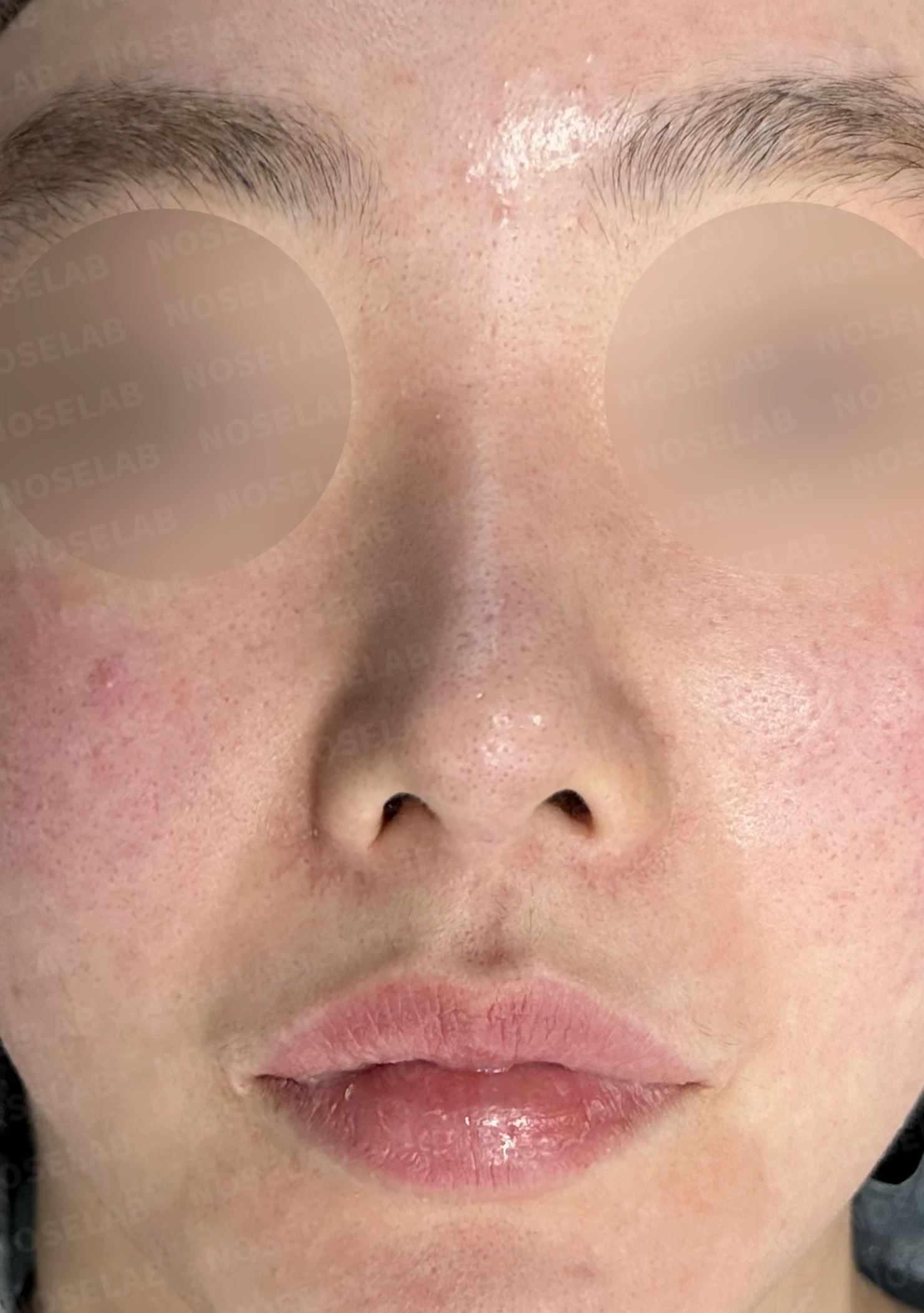 이물질 제거와 자가늑연골 비중격 재건, 들린 코 교정한 코재수술 — 전(좌) 직후(후)