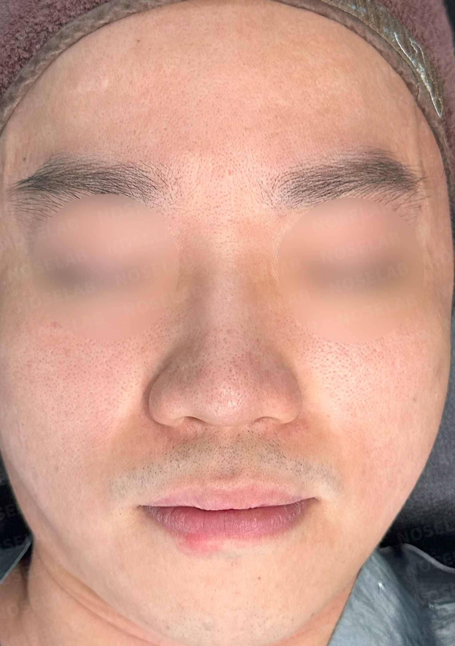 복코와 퍼진 코의 코성형 방법 — 수술 전 / 수술 직후 0일 직후 사진은 부기가 있는 상태로 최종 결과와 다를 수 있습니다.