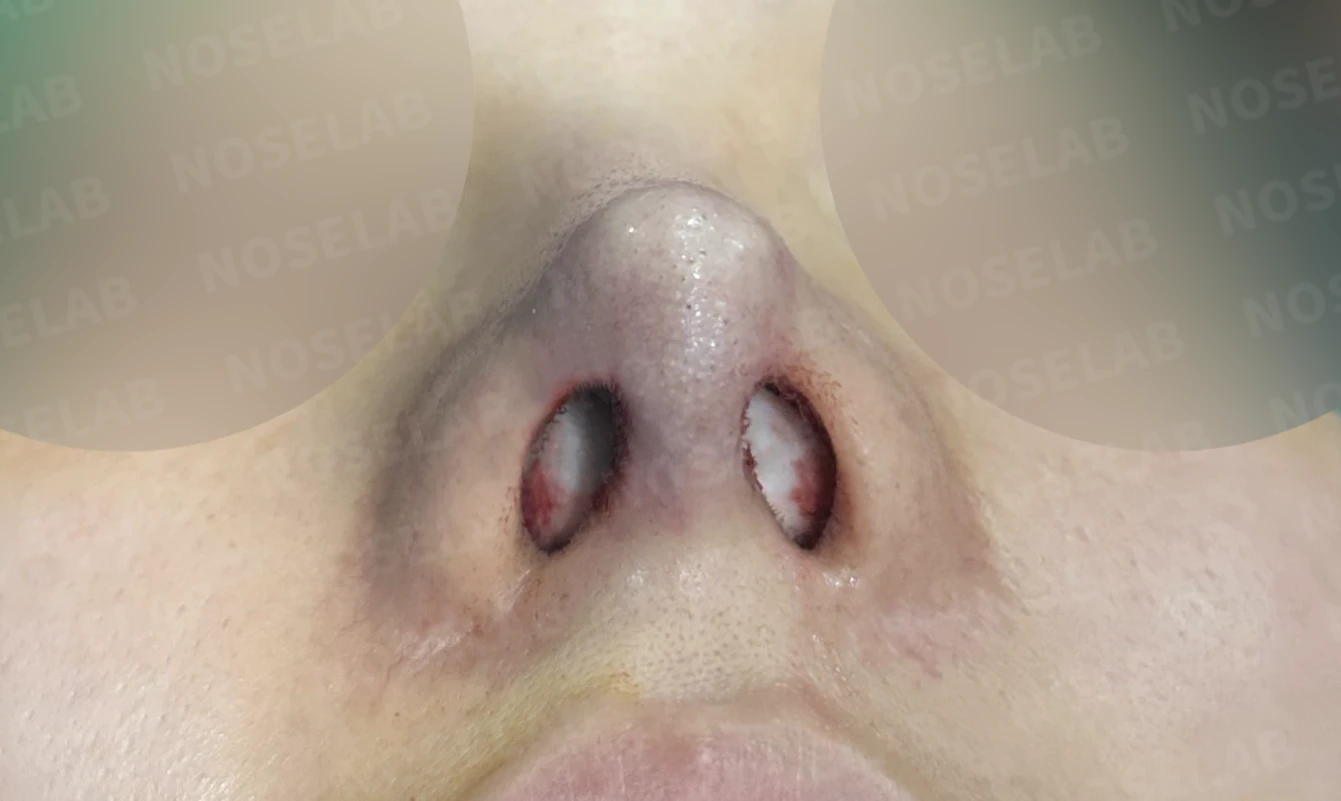 처지고 휘어진 코, 자가늑연골로 비중격 재건하고 코막힘까지 해결한 코재수술 사례 — 전(좌) 직후(후)