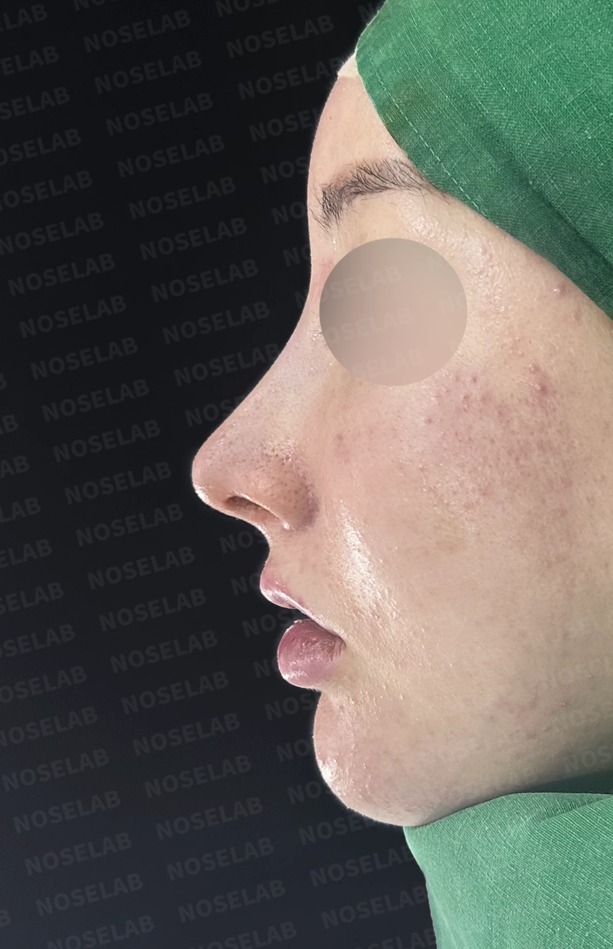 코가 길어 보이고 비주가 휘는 이유, 비중격 연장과 재건은 어떻게 하나 — 수술 직후 0일 정면, 비스듬한 측면, 측면 사진 직후 사진은 부기가 있는 상태로 최종 결과와 다를 수 있습니다.