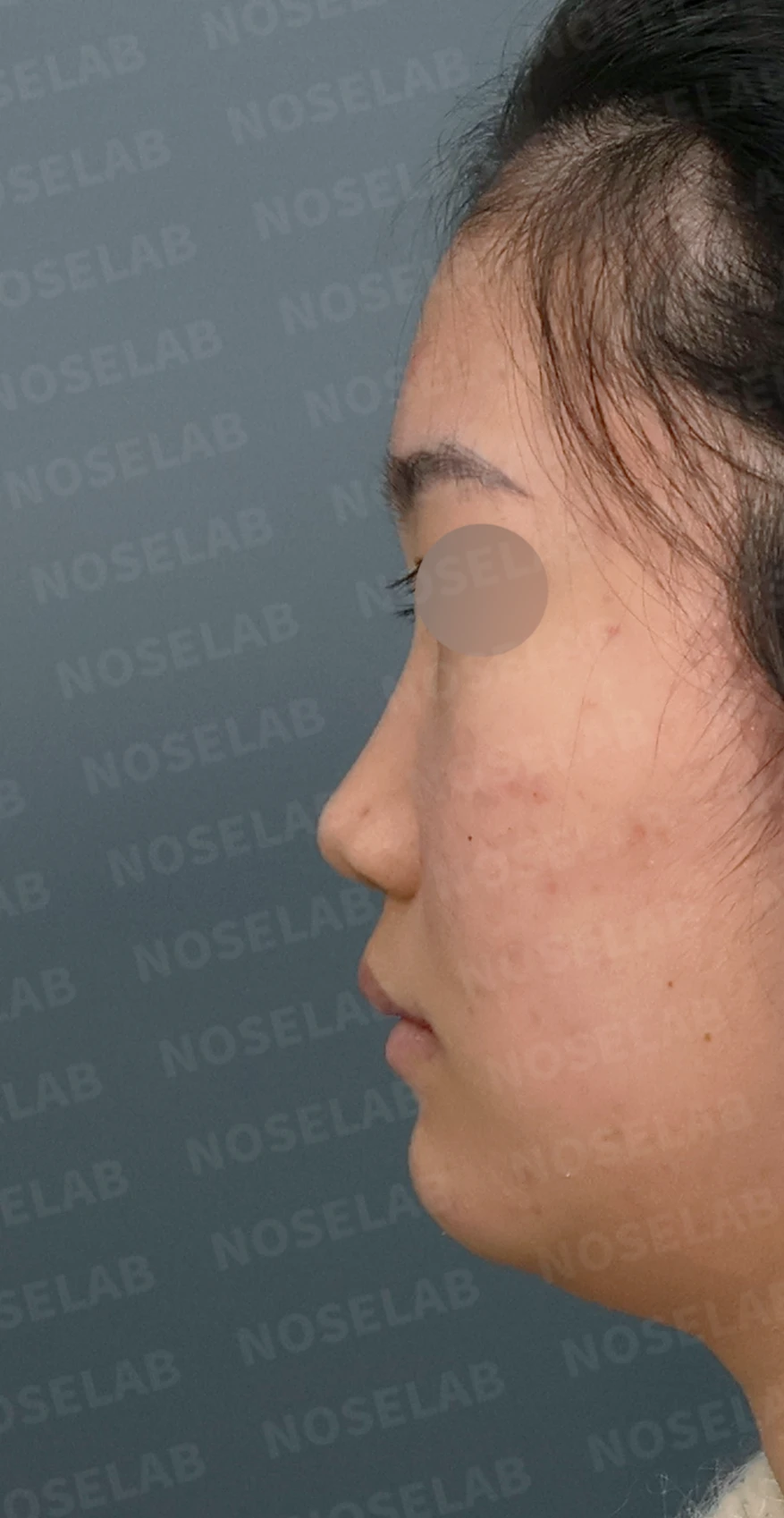 콧대가 낮고 코끝이 뭉툭해 보이는 이유, 함몰된 비주와 함께 교정하는 방법 — 디자인 상담 정면, 좌측 측면, 비스듬한 측면 사진입니다.