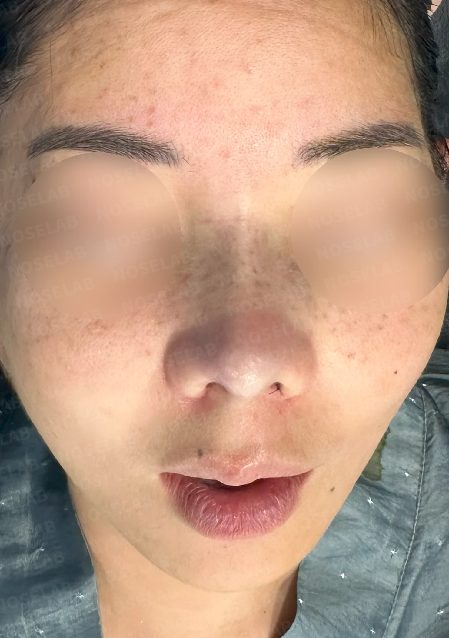 콧대가 평행선처럼 보이는 조건과 콧구멍 모양을 정하는 기준 — 수술 직후 0일 정면 , 비스듬한 측면 , 측면 사진입니다. 직후 사진은 부기가 있는 상태로 최종 결과와 다를 수 있습니다.