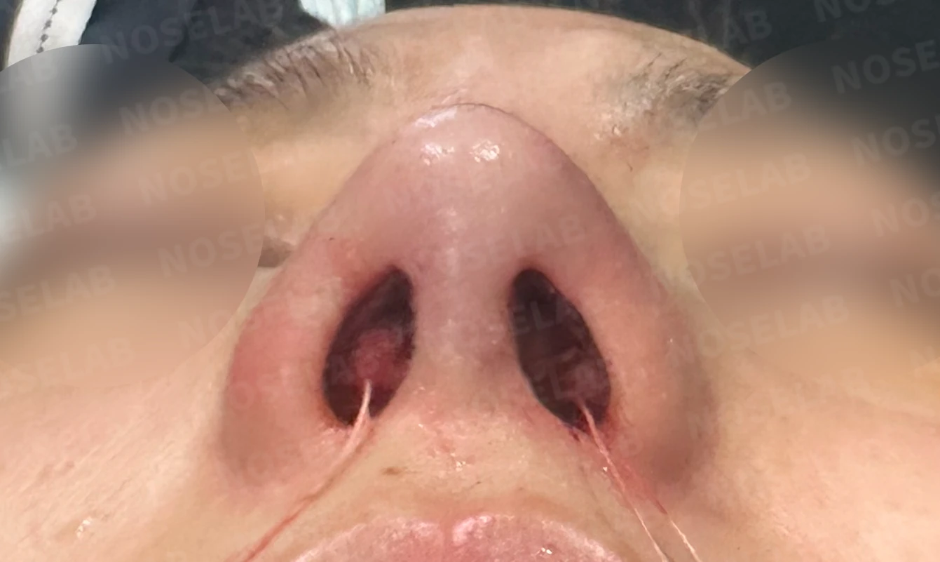 휘어진 코 교정과 비염 개선 - 자가늑연골 재건술 후기 — 직후 비공 사진입니다.
