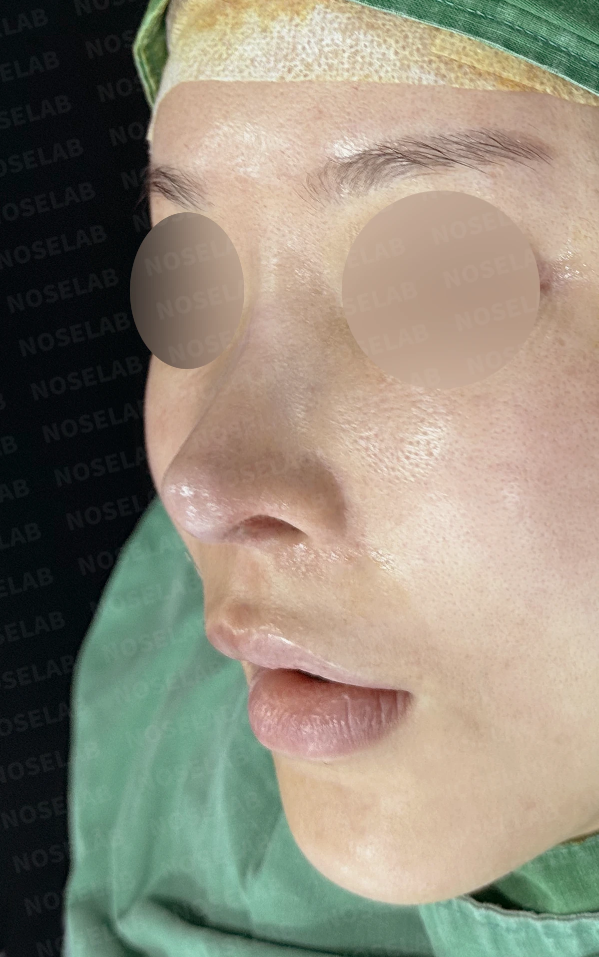 비중격 완전 재건으로 오똑한 코끝과 비공 비대칭 교정 — 전(좌) , 직후(후)