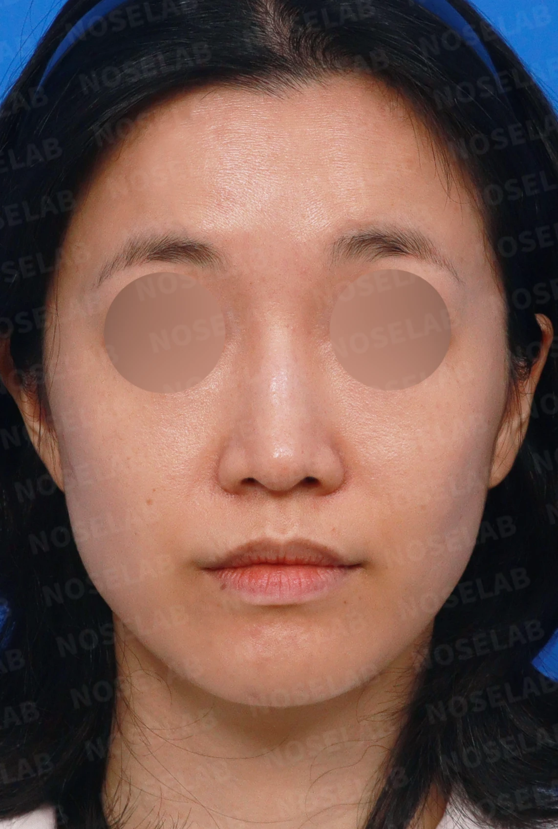 콧대 인공진피가 매부리로 남는 이유와 제거 후 재건 방법 — 디자인 상담 정면, 좌측 측면, 비스듬한 측면 사진입니다.