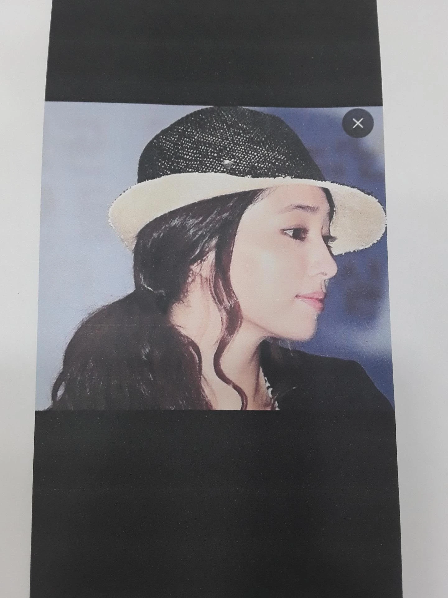 비중격 연골이 약해진 코, 보형물 없이 재건하는 방법 — 본문 사진 10