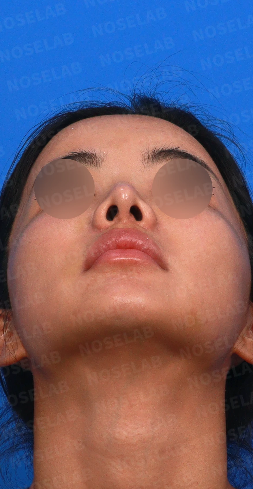 코성형 뒤 코끝이 처지고 웃을 때 퍼지는 이유, 이물질 제거와 코끝 교정 방법 — 디자인 상담 우측 측면, 비스듬한 측면, 비공 사진입니다.
