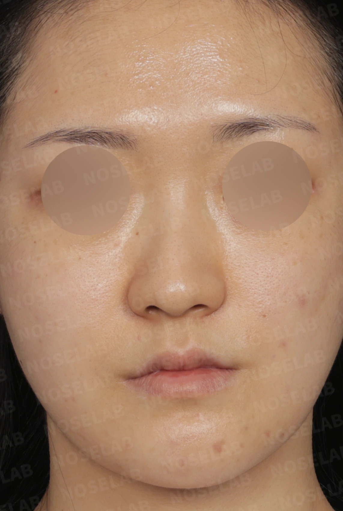 안면 비대칭과 휜코, 자가늑연골 비중격 재건으로 자연스럽게 교정한 코성형 — 디자인 상담 정면, 좌측 측면, 비스듬한 측면 사진입니다.