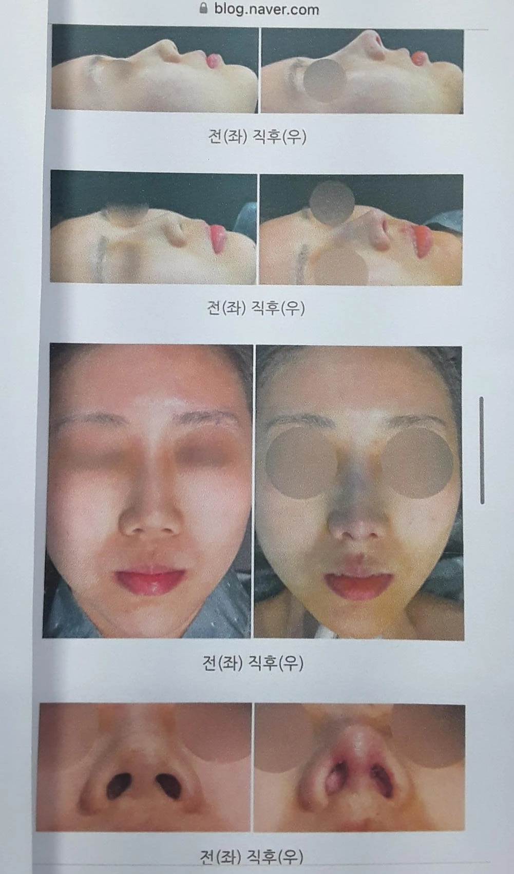 양악수술 뒤 코가 퍼지고 막히는 이유, 기능과 형태를 함께 보는 방법 — 환자분 원하시던 이미지입니다.