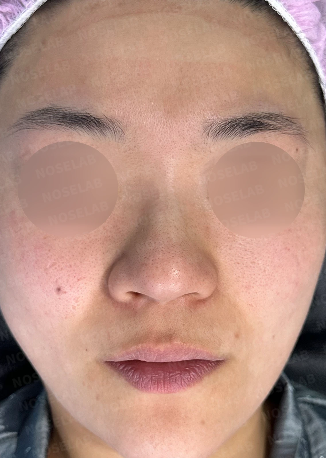 복코 수술은 어떻게 하나요? — 수술 전 / 수술 직후 0일 직후 사진은 부기가 있는 상태로 최종 결과와 다를 수 있습니다.