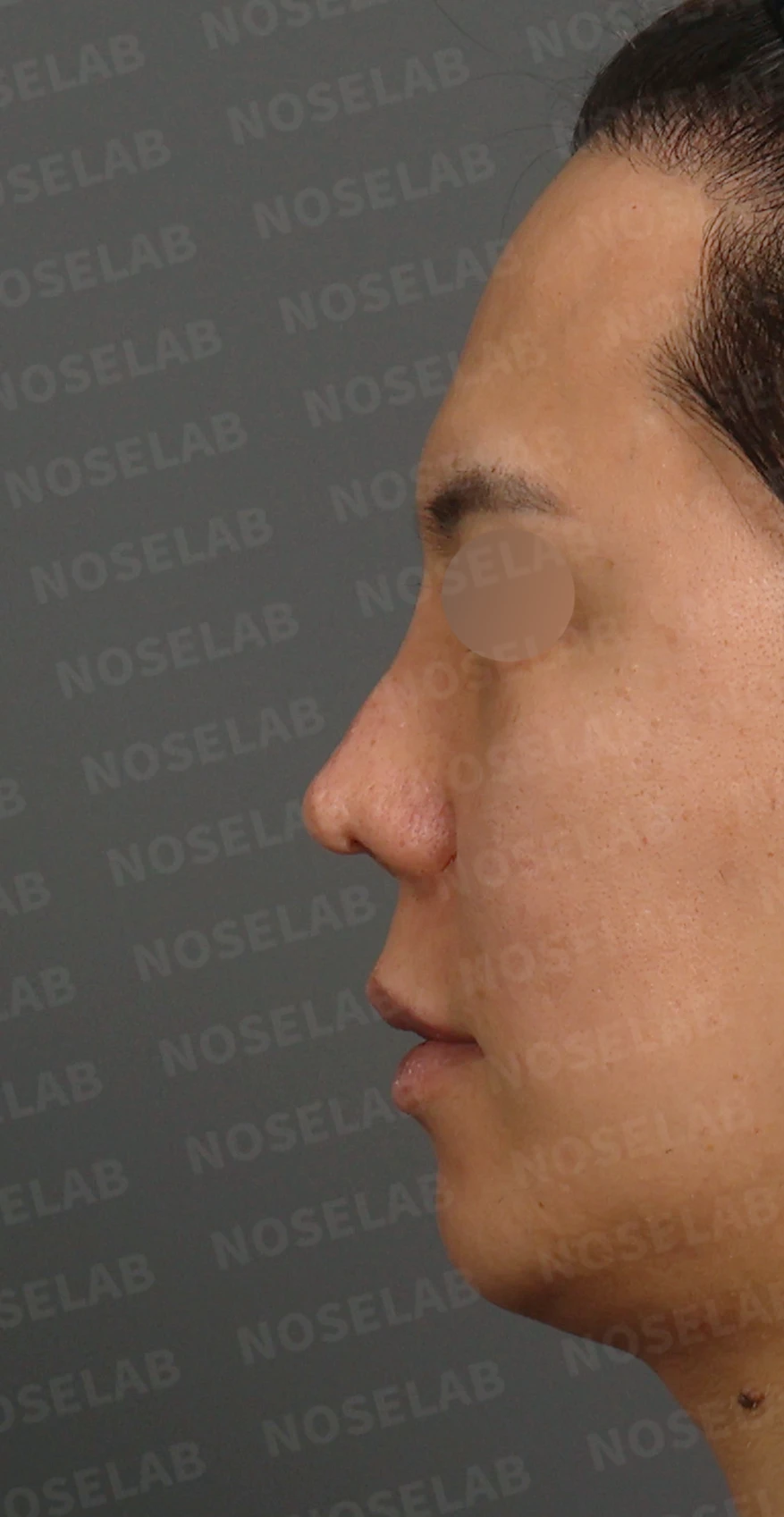여러 차례 코재수술 후 구축 변형, 자가늑연골로 재건한 사례 — 디자인 상담 정면, 좌측 측면, 비스듬한 측면 사진입니다.