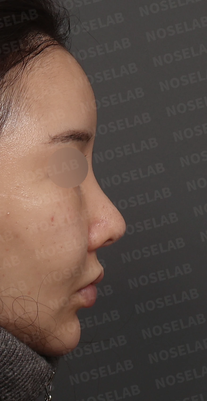 휘어진 코와 비공 비대칭, 자가늑연골 비중격 재건으로 완성한 코재수술 — 디자인 상담 우측 측면, 비스듬한 측면, 비공 사진