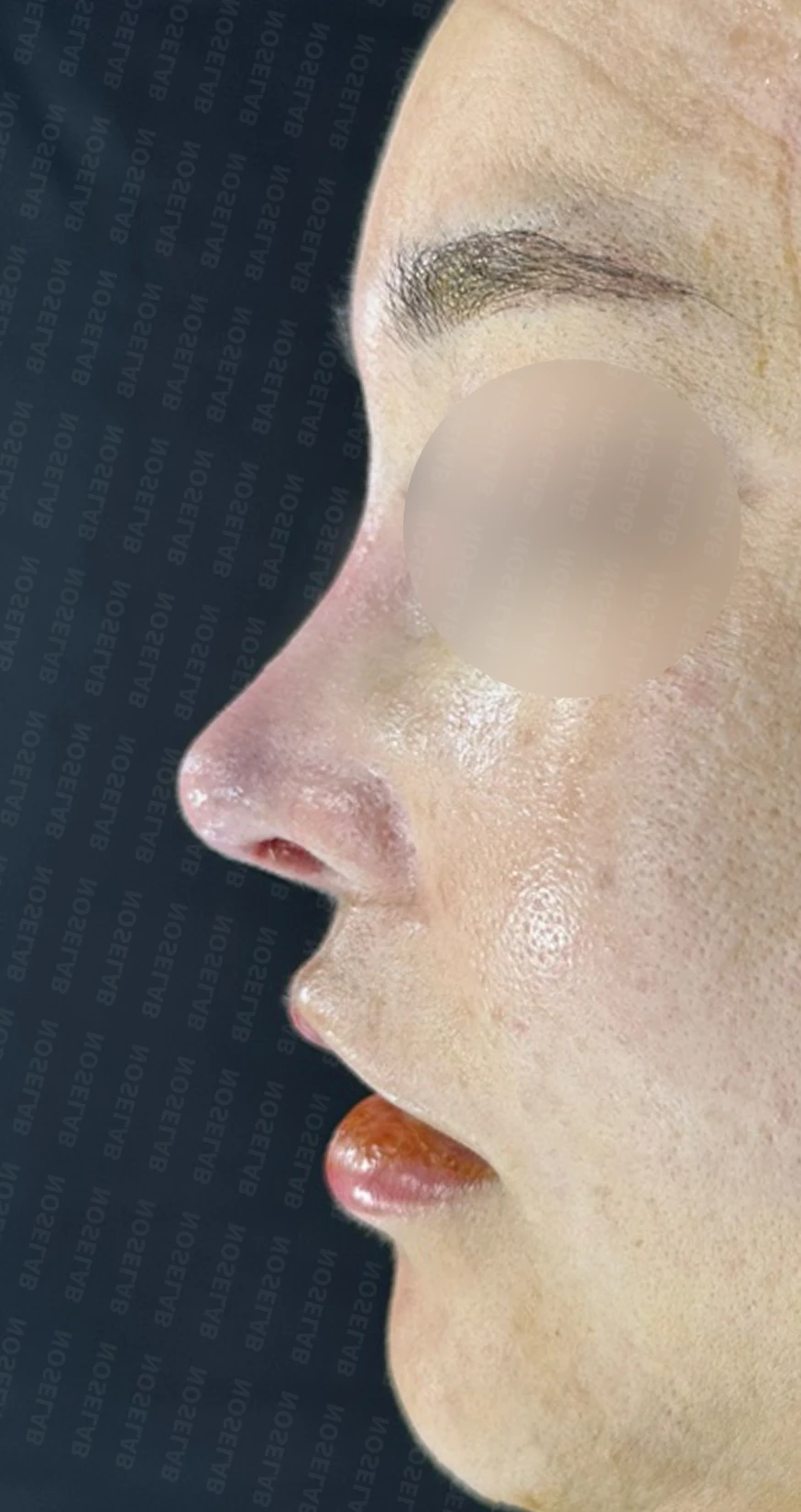 코재수술에서 비중격을 재건하는 방법 — 수술 직후 0일 정면, 비스듬한 측면, 측면 사진 직후 사진은 부기가 있는 상태로 최종 결과와 다를 수 있습니다.