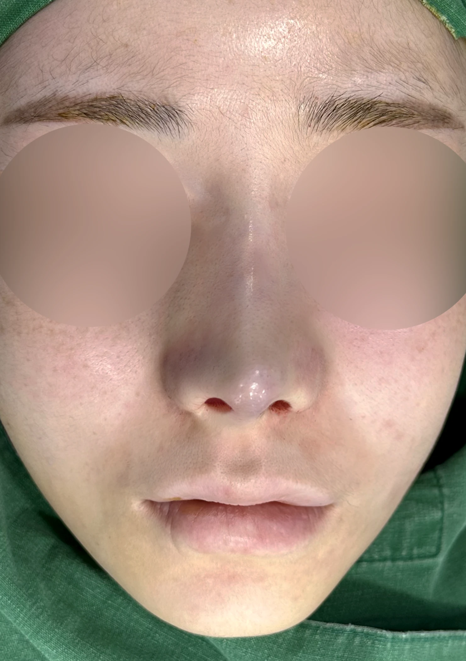 코성형 뒤 코끝이 들리고 비주가 짧아 보이는 이유, 비주 하강과 콧대 라인 교정 방법 — 수술 전 / 수술 직후 0일 직후 사진은 부기가 있는 상태로 최종 결과와 다를 수 있습니다.