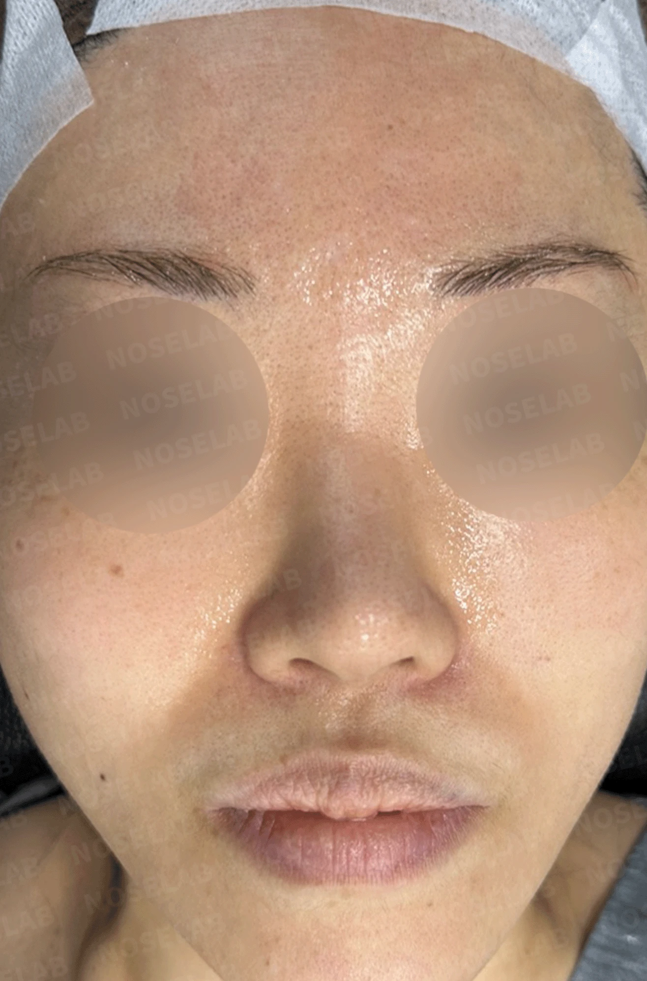 인공진피가 흡수되며 콧대가 낮아지고 퍼지는 이유 — 본문 사진 7