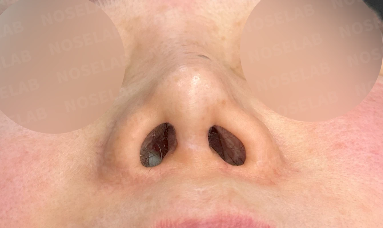 귀족수술 보형물이 코 안으로 밀려 나와 숨이 막히는 이유와 재건 방법 — 본문 사진 14