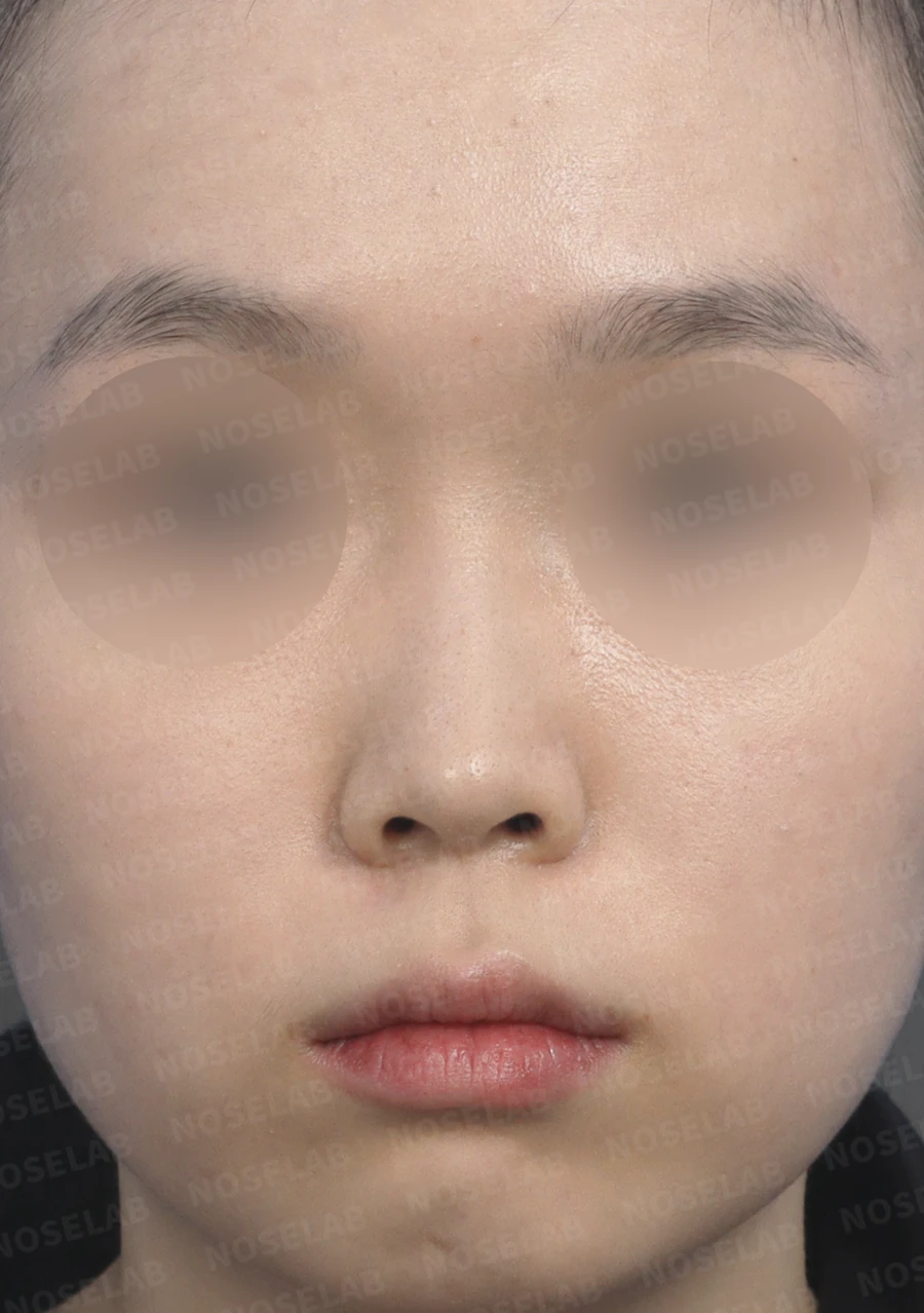 짧은 코의 비개방 교정 방법과 얼굴 비율 — 수술 전 / 수술 직후 0일 직후 사진은 부기가 있는 상태로 최종 결과와 다를 수 있습니다.